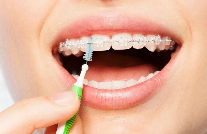 Bàn chải đánh răng dành cho người chỉnh nha khoa